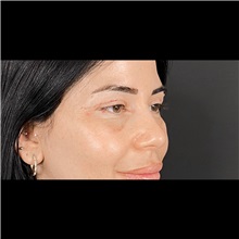 Eyelid Surgery After Photo by Cem Berkay SINACI, MD; Istanbul, M - Case 51045