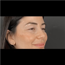 Eyelid Surgery Before Photo by Cem Berkay SINACI, MD; Istanbul, M - Case 51045