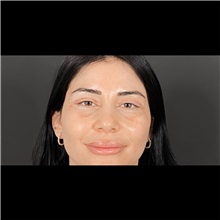 Eyelid Surgery After Photo by Cem Berkay SINACI, MD; Istanbul, M - Case 51045