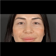 Eyelid Surgery Before Photo by Cem Berkay SINACI, MD; Istanbul, M - Case 51045