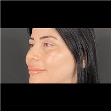 Eyelid Surgery After Photo by Cem Berkay SINACI, MD; Istanbul, M - Case 51045