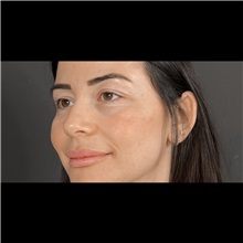 Eyelid Surgery Before Photo by Cem Berkay SINACI, MD; Istanbul, M - Case 51045