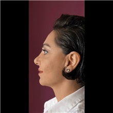 Cheek Reduction After Photo by Cem Berkay SINACI, MD; Istanbul, M - Case 51052