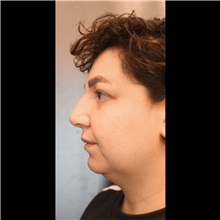 Cheek Reduction Before Photo by Cem Berkay SINACI, MD; Istanbul, M - Case 51052
