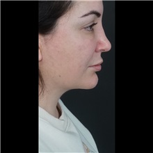 Cheek Reduction After Photo by Cem Berkay SINACI, MD; Istanbul, M - Case 51054
