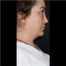 Cheek Reduction Before Photo by Cem Berkay SINACI, MD; Istanbul, M - Case 51054