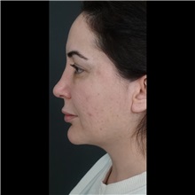 Cheek Reduction After Photo by Cem Berkay SINACI, MD; Istanbul, M - Case 51054