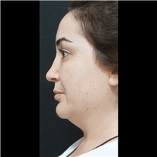 Cheek Reduction Before Photo by Cem Berkay SINACI, MD; Istanbul, M - Case 51054