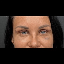 Eyelid Surgery After Photo by Cem Berkay SINACI, MD; Istanbul, M - Case 51046