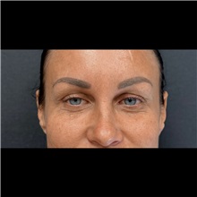 Eyelid Surgery Before Photo by Cem Berkay SINACI, MD; Istanbul, M - Case 51046
