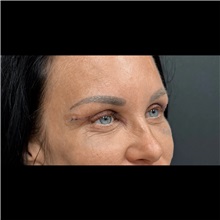 Eyelid Surgery After Photo by Cem Berkay SINACI, MD; Istanbul, M - Case 51046