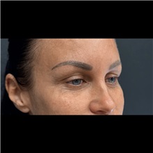 Eyelid Surgery Before Photo by Cem Berkay SINACI, MD; Istanbul, M - Case 51046