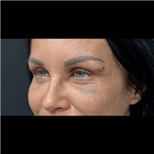 Eyelid Surgery After Photo by Cem Berkay SINACI, MD; Istanbul, M - Case 51046