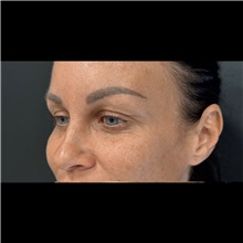 Eyelid Surgery Before Photo by Cem Berkay SINACI, MD; Istanbul, M - Case 51046