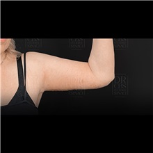 Arm Lift After Photo by Cem Berkay SINACI, MD; Istanbul, M - Case 51044