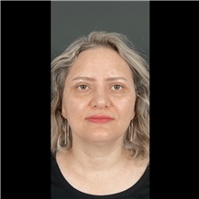 Eyelid Surgery After Photo by Cem Berkay SINACI, MD; Istanbul, M - Case 51047