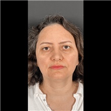 Eyelid Surgery Before Photo by Cem Berkay SINACI, MD; Istanbul, M - Case 51047