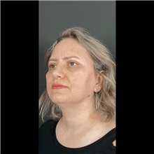 Eyelid Surgery After Photo by Cem Berkay SINACI, MD; Istanbul, M - Case 51047