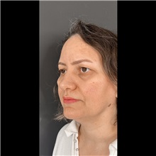 Eyelid Surgery Before Photo by Cem Berkay SINACI, MD; Istanbul, M - Case 51047