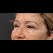 Eyelid Surgery After Photo by Cem Berkay SINACI, MD; Istanbul, M - Case 51050