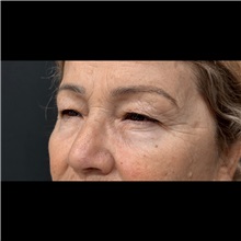 Eyelid Surgery Before Photo by Cem Berkay SINACI, MD; Istanbul, M - Case 51050