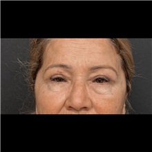 Eyelid Surgery After Photo by Cem Berkay SINACI, MD; Istanbul, M - Case 51050