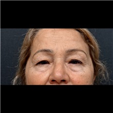 Eyelid Surgery Before Photo by Cem Berkay SINACI, MD; Istanbul, M - Case 51050