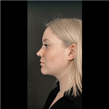 Cheek Reduction After Photo by Cem Berkay SINACI, MD; Istanbul, M - Case 51053