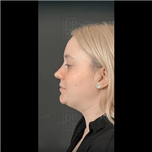 Cheek Reduction Before Photo by Cem Berkay SINACI, MD; Istanbul, M - Case 51053