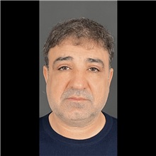 Eyelid Surgery After Photo by Cem Berkay SINACI, MD; Istanbul, M - Case 51048