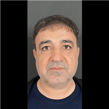Eyelid Surgery Before Photo by Cem Berkay SINACI, MD; Istanbul, M - Case 51048
