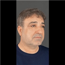 Eyelid Surgery After Photo by Cem Berkay SINACI, MD; Istanbul, M - Case 51048