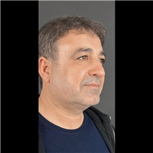 Eyelid Surgery Before Photo by Cem Berkay SINACI, MD; Istanbul, M - Case 51048