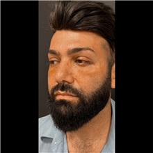 Eyelid Surgery After Photo by Cem Berkay SINACI, MD; Istanbul, M - Case 51051