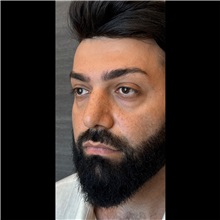Eyelid Surgery Before Photo by Cem Berkay SINACI, MD; Istanbul, M - Case 51051