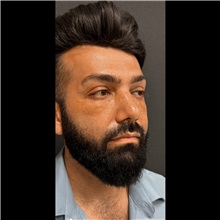 Eyelid Surgery After Photo by Cem Berkay SINACI, MD; Istanbul, M - Case 51051