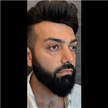Eyelid Surgery Before Photo by Cem Berkay SINACI, MD; Istanbul, M - Case 51051