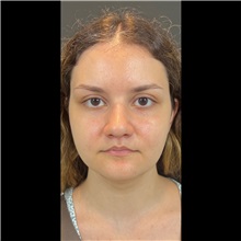 Lip Augmentation/Enhancement After Photo by Cem Berkay SINACI, MD; Istanbul, M - Case 51068