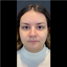 Lip Augmentation/Enhancement Before Photo by Cem Berkay SINACI, MD; Istanbul, M - Case 51068