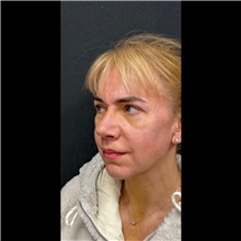 Chin Augmentation After Photo by Cem Berkay SINACI, MD; Istanbul, M - Case 51058