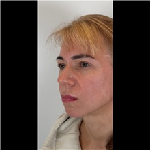 Chin Augmentation Before Photo by Cem Berkay SINACI, MD; Istanbul, M - Case 51058
