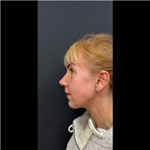 Chin Augmentation After Photo by Cem Berkay SINACI, MD; Istanbul, M - Case 51058