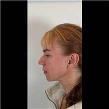 Chin Augmentation Before Photo by Cem Berkay SINACI, MD; Istanbul, M - Case 51058