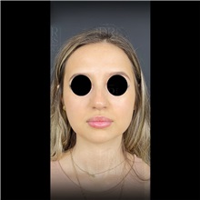 Cheek Reduction After Photo by Cem Berkay SINACI, MD; Istanbul, M - Case 51055