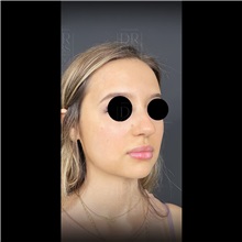 Cheek Reduction After Photo by Cem Berkay SINACI, MD; Istanbul, M - Case 51055