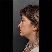 Liposuction After Photo by Cem Berkay SINACI, MD; Istanbul, M - Case 51062