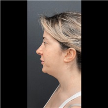 Liposuction Before Photo by Cem Berkay SINACI, MD; Istanbul, M - Case 51062