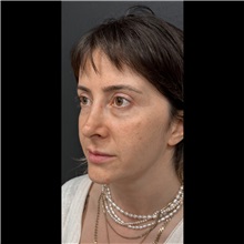 Liposuction After Photo by Cem Berkay SINACI, MD; Istanbul, M - Case 51062
