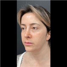 Liposuction Before Photo by Cem Berkay SINACI, MD; Istanbul, M - Case 51062