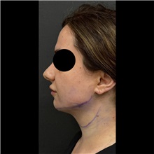 Liposuction After Photo by Cem Berkay SINACI, MD; Istanbul, M - Case 51065